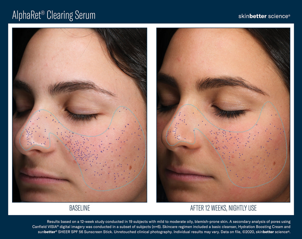 AlphaRet Clearing Serum 30 ml