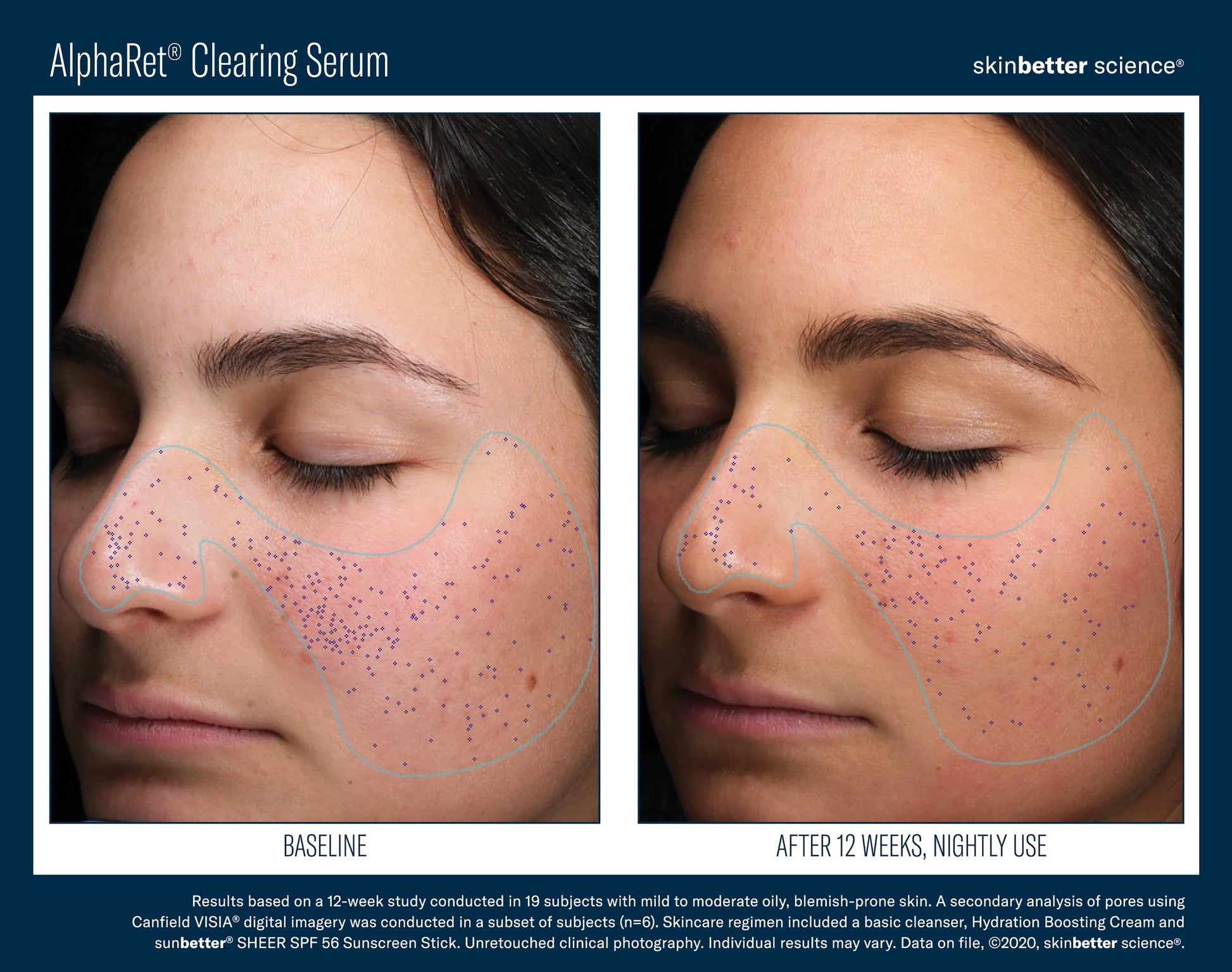 AlphaRet Clearing Serum 30 ml