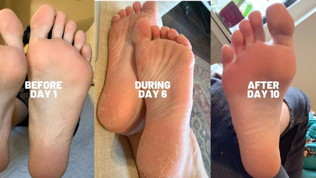 Original Exfoliation Foot Peel
